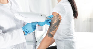 Frau unterzieht sich einer Laser-Tätowierungsentfernung